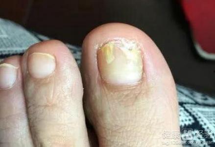 婆婆妈妈爆料灰指甲视频  第1张